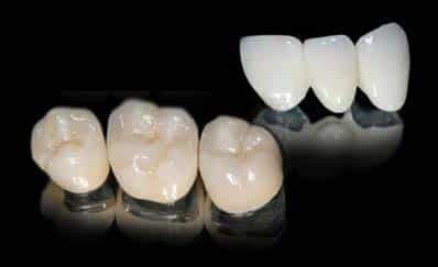 PFM dental crown restoration