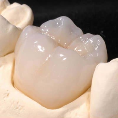 Z-Max full zirconia molar restoration