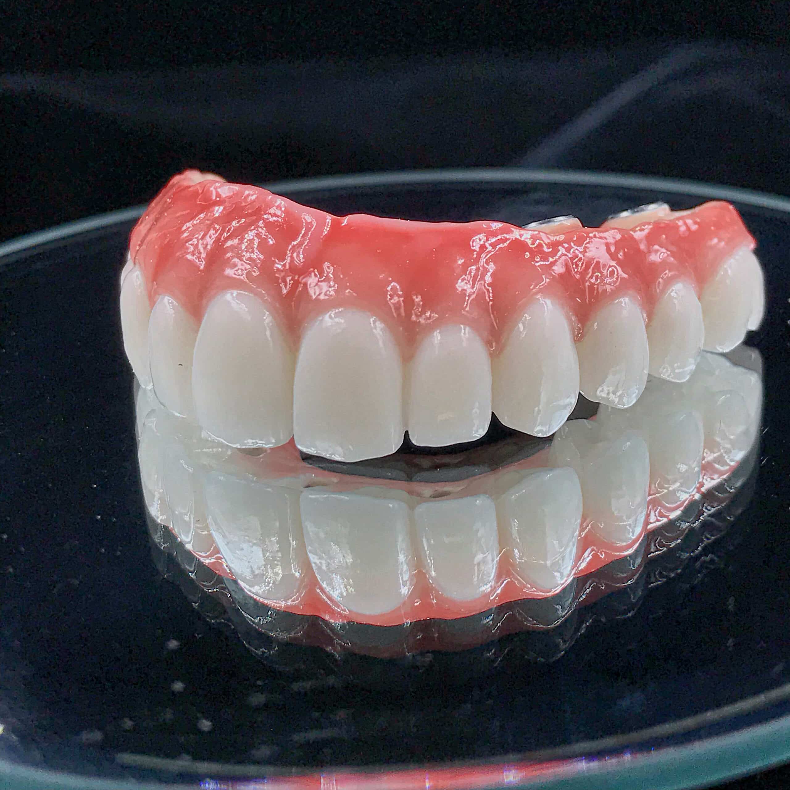 All-On-4 hybrid dental restoration