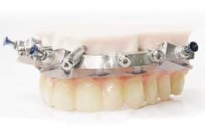 CHROME GuidedSMILE full arch planning