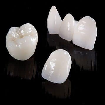 E-Max dental restoration